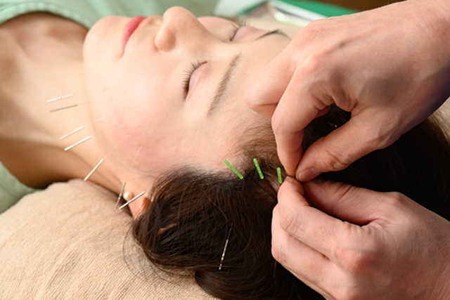 美容鍼