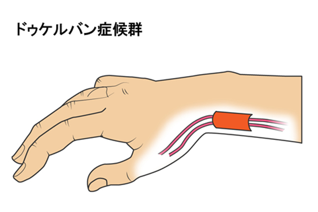 腱鞘炎