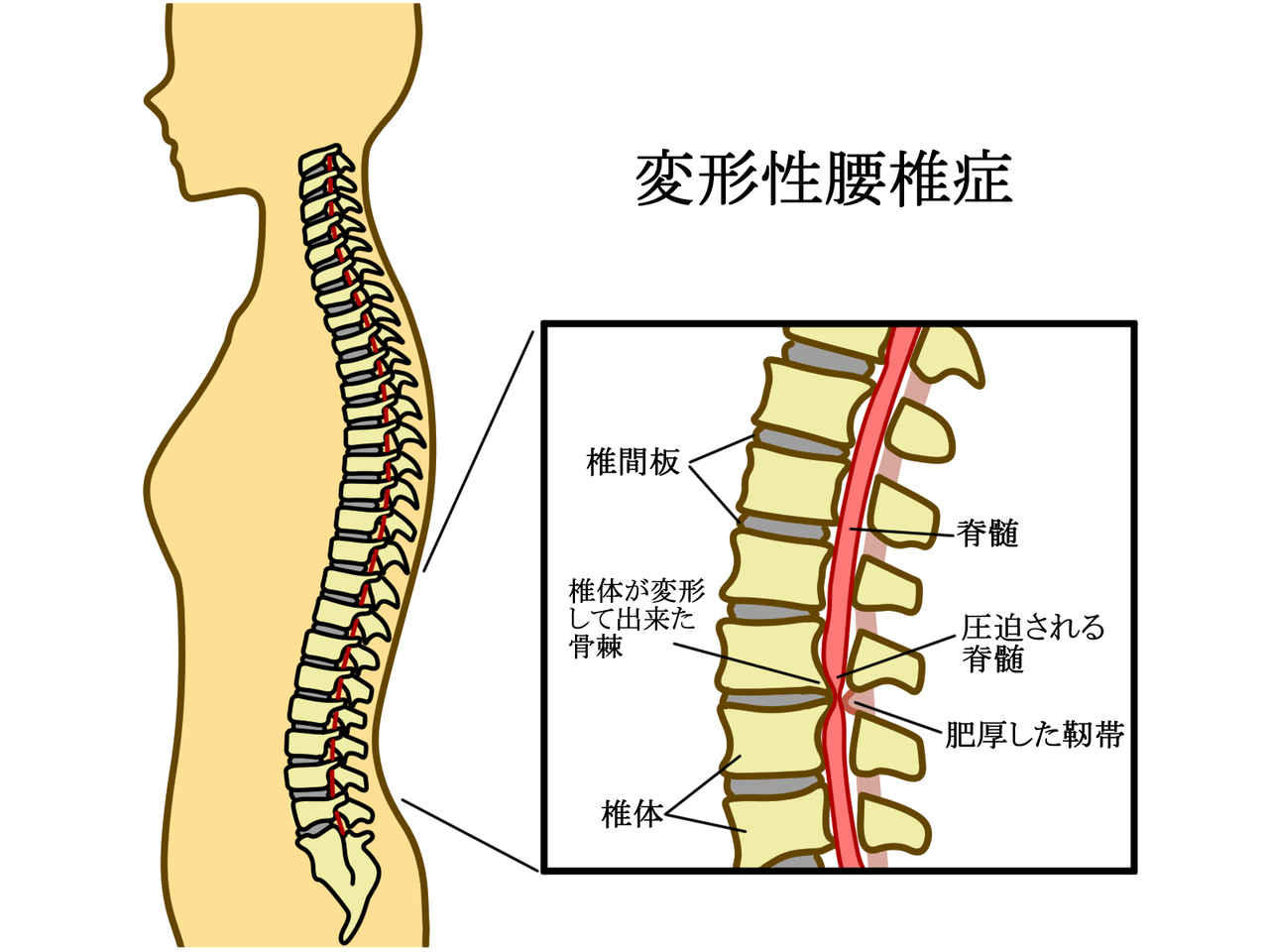 変形性腰椎症イラスト